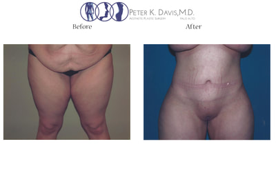 After Weight Loss & Mommy Make-over by Dr. Peter Davis — before and after
