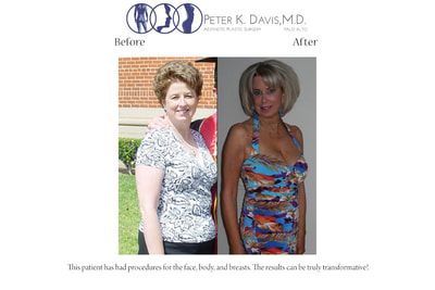 After Weight Loss & Mommy Make-over by Dr. Peter Davis — before and after