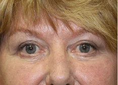 Blepharoplasty before and after - after