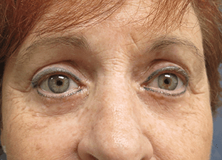 Blepharoplasty before and after - after