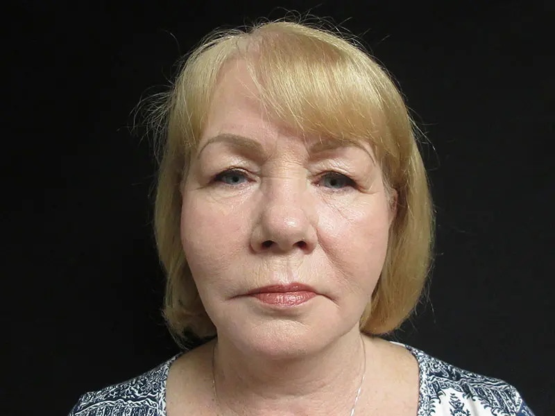 Facelift before and after - after