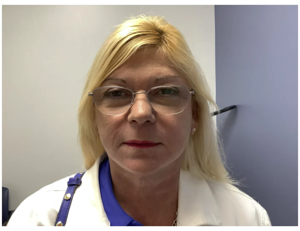 Facelift before and after - after