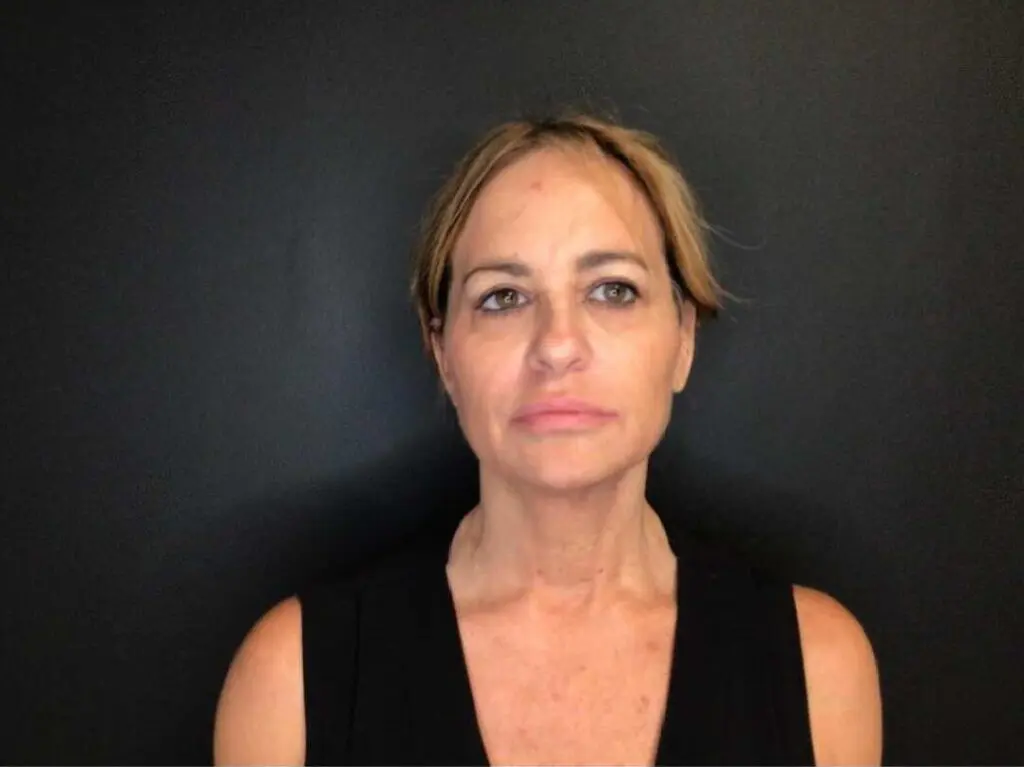 Facelift before and after - before