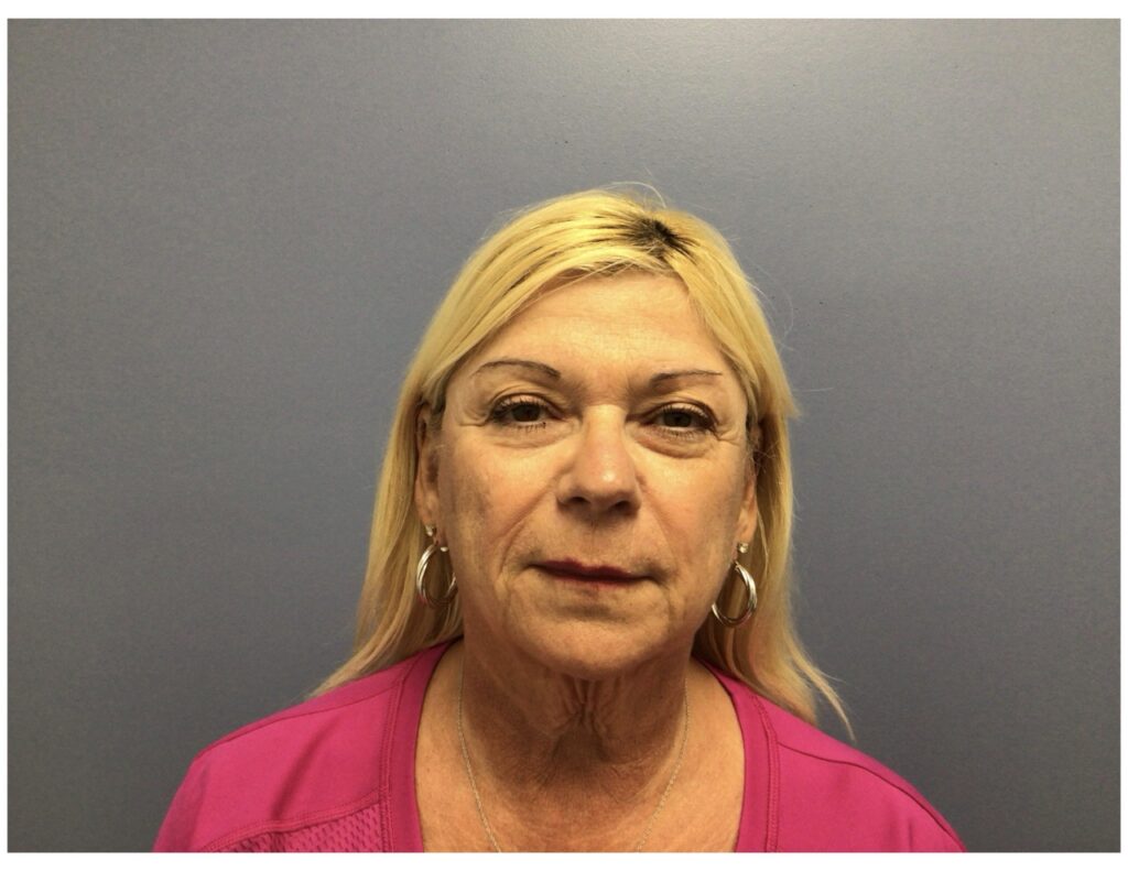 Facelift before and after - before