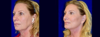 Facelift, Browlift & Rhinoplasty before and after - after