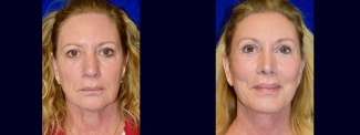 Facelift, Browlift & Rhinoplasty before and after - before