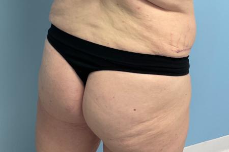 Butt Lift before and after - after