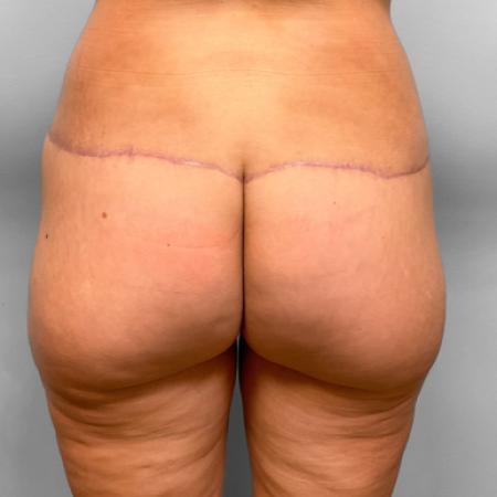 Butt Lift before and after - after