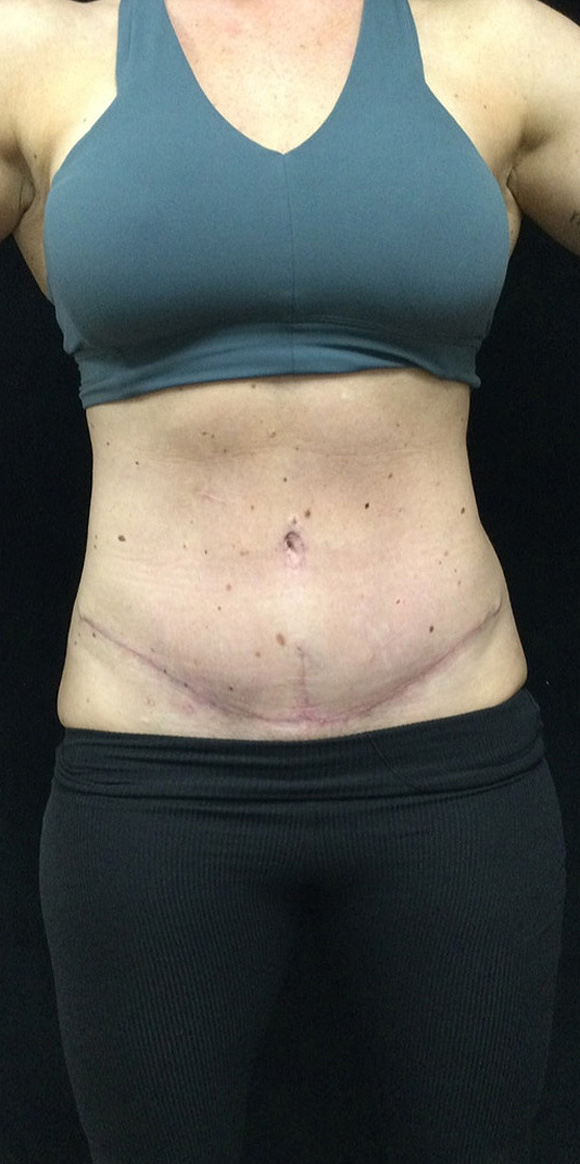 Abdominoplasty before and after - after