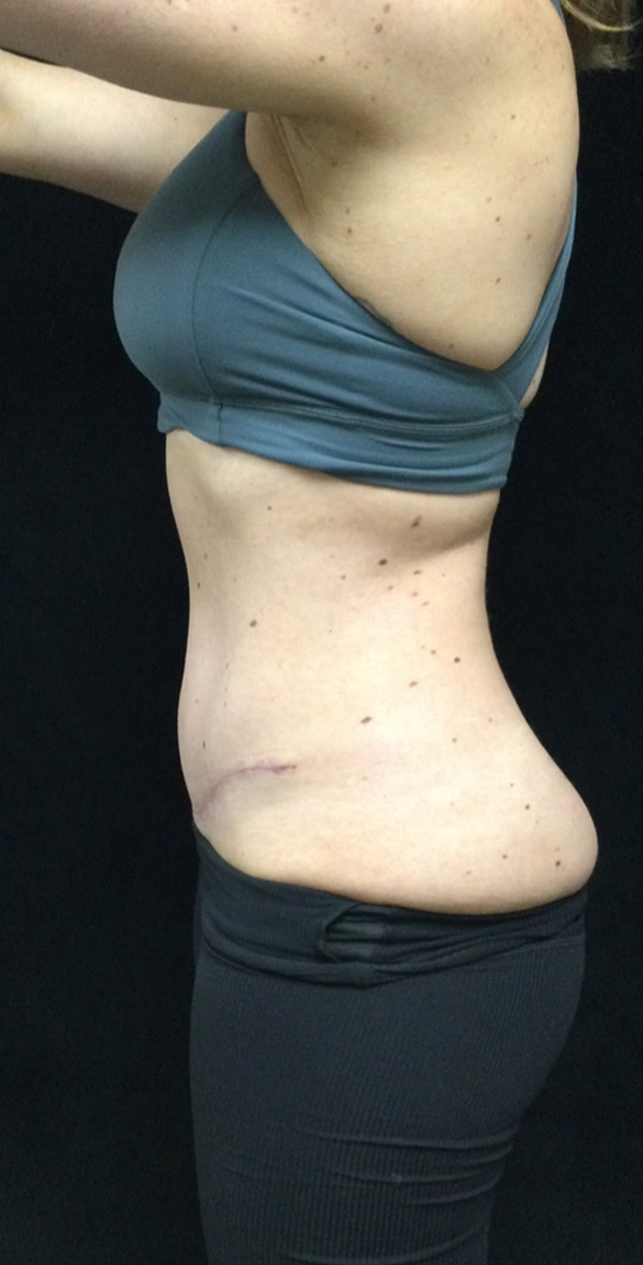 Abdominoplasty (Tummy Tuck) before and after - after