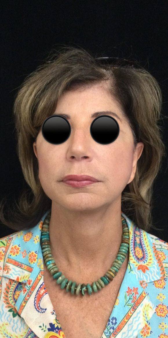 Facelift before and after - after