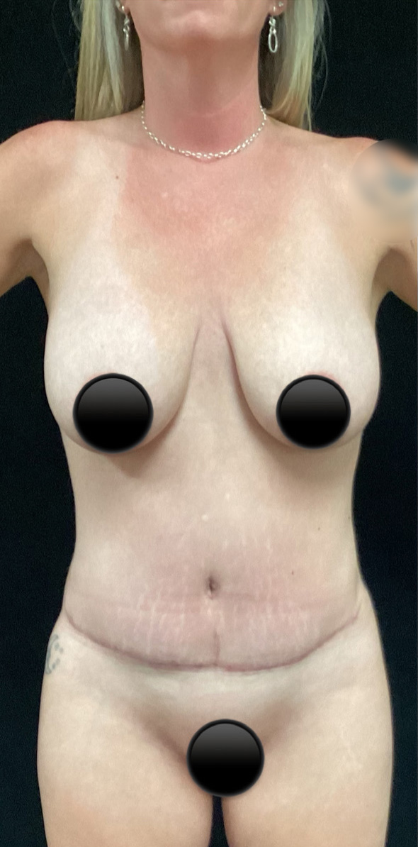Breast Augmentation before and after - after