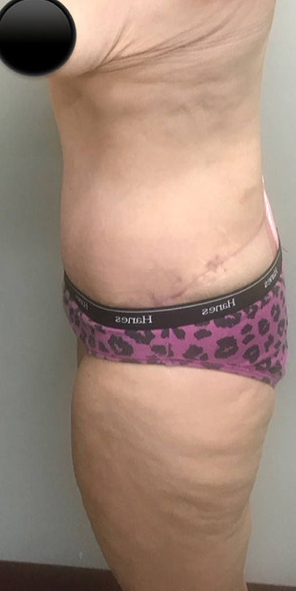 Abdominoplasty before and after - after