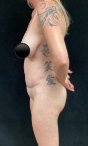 Abdominoplasty (Tummy Tuck) before and after - after