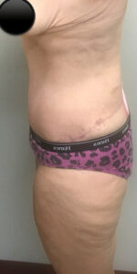 Abdominoplasty (Tummy Tuck) before and after - after