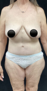 Abdominoplasty (Tummy Tuck) before and after - after