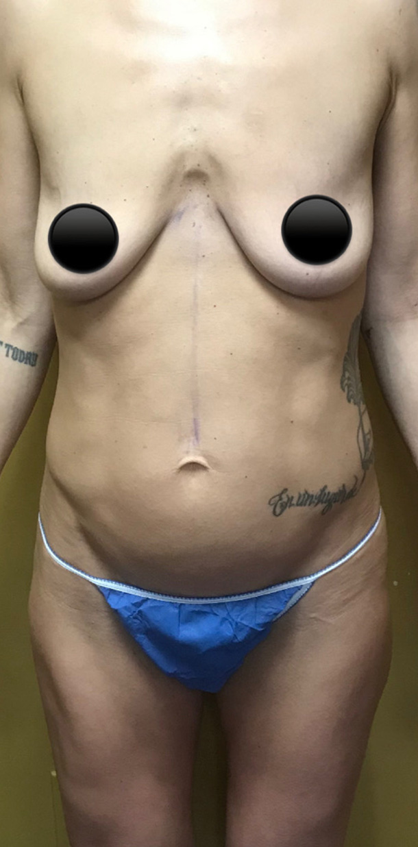 Abdominoplasty before and after - before