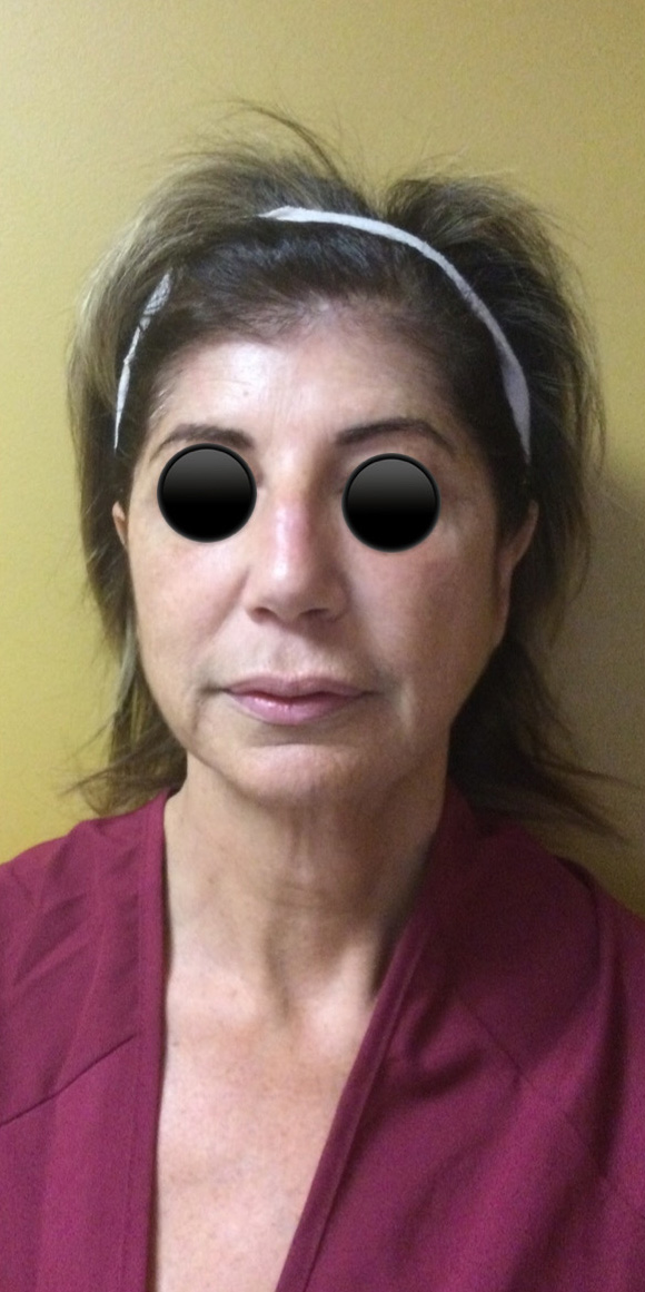 Facelift before and after - before