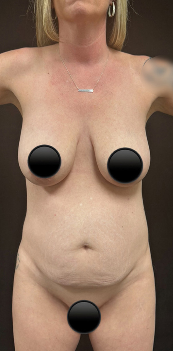 Breast Augmentation before and after - before