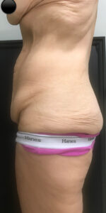 Abdominoplasty (Tummy Tuck) before and after - before
