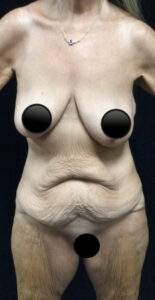 Abdominoplasty (Tummy Tuck) before and after - before