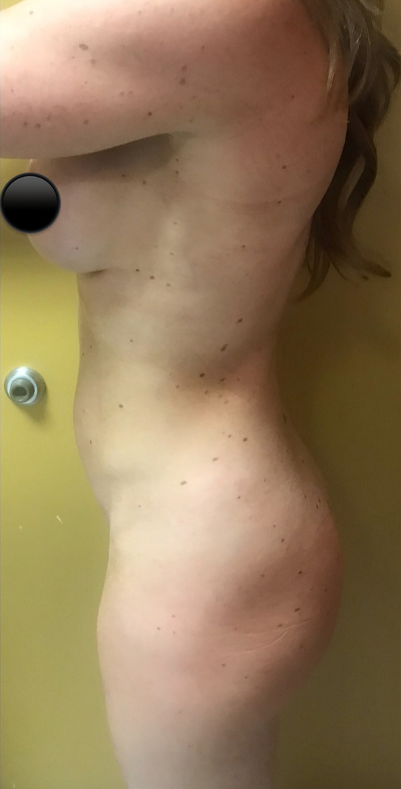 Abdominoplasty (Tummy Tuck) before and after - before