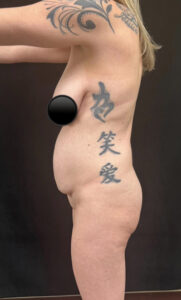 Abdominoplasty (Tummy Tuck) before and after - before