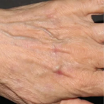 Brazilian Butt Lift by Dr. Anahita Azharian — after