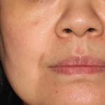 Brazilian Butt Lift by Dr. Anahita Azharian — after