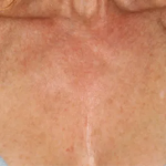 Brazilian Butt Lift by Dr. Anahita Azharian — after