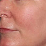 Brazilian Butt Lift by Dr. Anahita Azharian — after