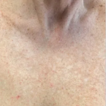 Brazilian Butt Lift by Dr. Anahita Azharian — after