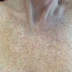 Brazilian Butt Lift by Dr. Anahita Azharian — before