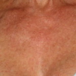 Brazilian Butt Lift by Dr. Anahita Azharian — before