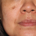 Brazilian Butt Lift by Dr. Anahita Azharian — before