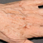 Brazilian Butt Lift by Dr. Anahita Azharian — before