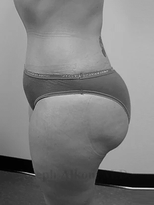 Procedure before and after - after