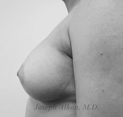 Procedure before and after - after