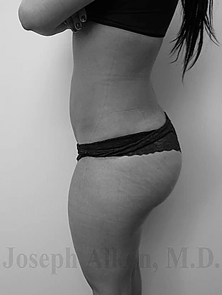 Procedure before and after - after