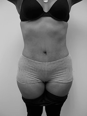 Procedure before and after - after