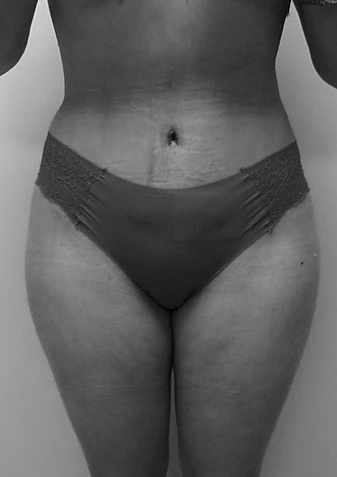 Procedure before and after - after