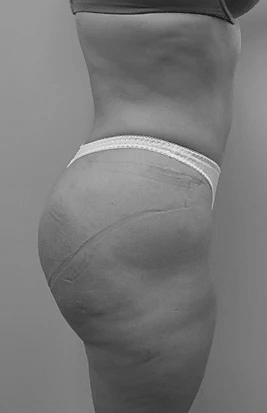 Procedure before and after - after