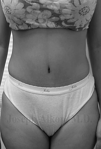 Procedure before and after - after