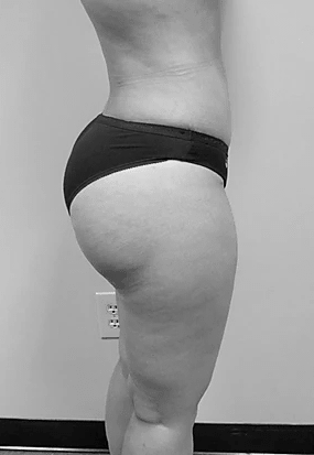Procedure before and after - after