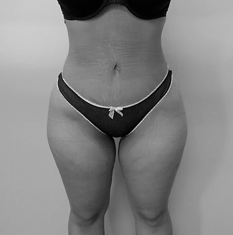 Procedure before and after - after