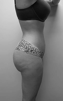 Procedure before and after - after