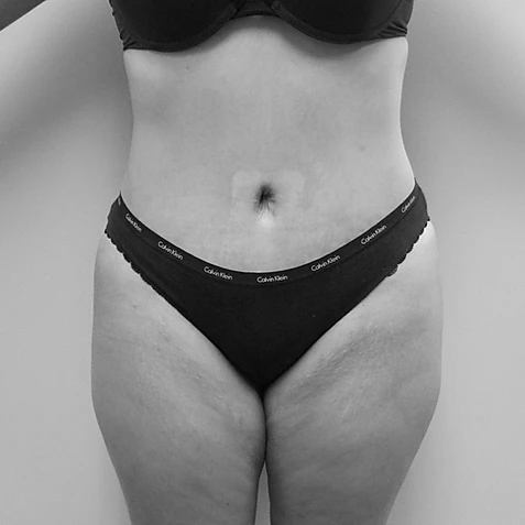 Procedure before and after - after