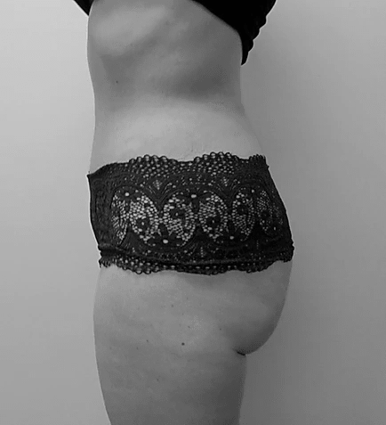 Procedure before and after - after