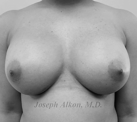 Procedure before and after - after