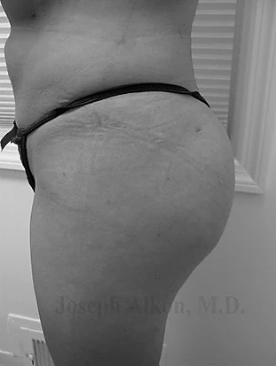Procedure before and after - after